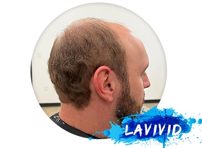 Will Sleeping in a Hair System Destroy its Lifespan?!