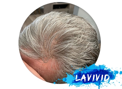 Best Models of Non-Surgical Men's Hairpieces