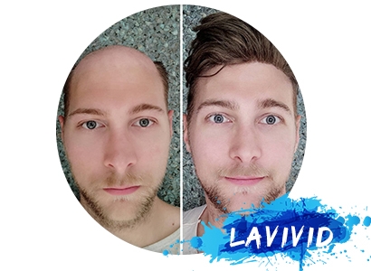 The Guide to Cure the Male Hair Loss